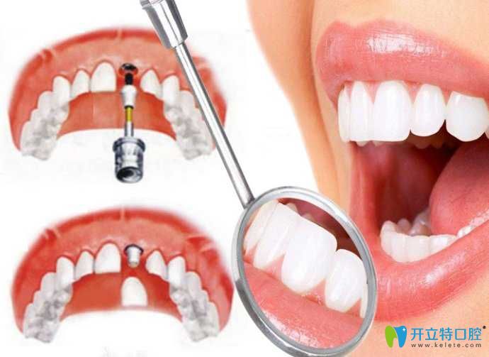 寧波恒美口腔王曉光介紹種植牙適應(yīng)癥