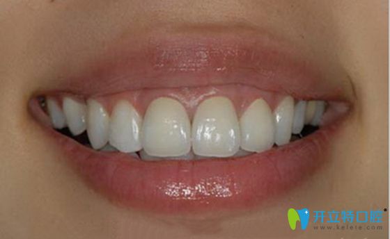 全瓷牙冠修復(fù)后真人<span style=