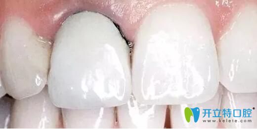 深圳全瓷牙多少錢(qián)?參考威蘭德、愛(ài)爾創(chuàng)二氧化鋯全瓷牙價(jià)格