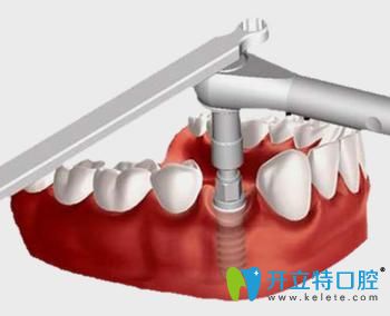 寧波恒美口腔王敬彬即刻負重種植牙好處