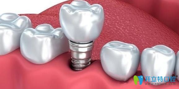 咸陽海濤口腔種植牙技術(shù)