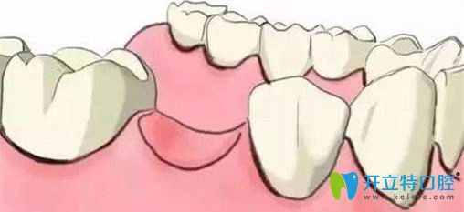 牙齒缺失不及時(shí)修復(fù)的危害