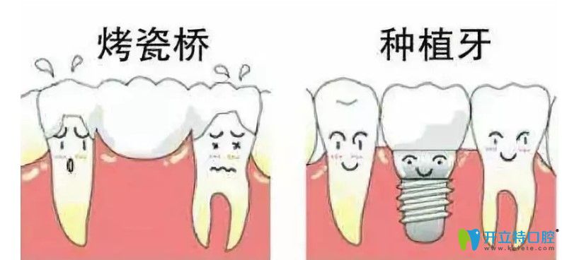 李勝剛解析牙齒缺失選擇種植牙好還是烤瓷牙好