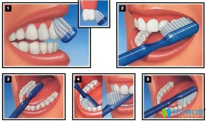 郝婷醫(yī)生告訴大家正確的刷牙方法