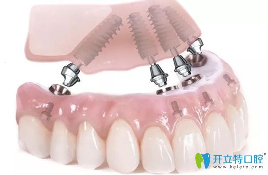 無錫北極星All-on-4半口種植技術