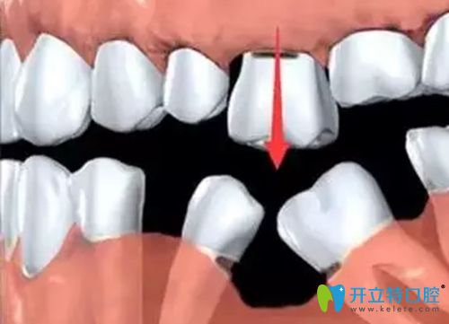 缺一顆牙后會(huì)引起臨牙脫落