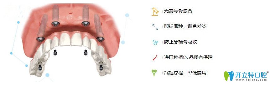 半口種植牙的方法有哪些