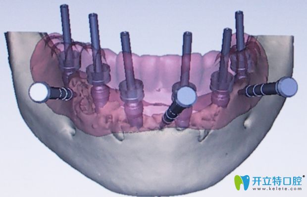 3D導(dǎo)板種植技術(shù)圖 3D導(dǎo)板種植技術(shù)圖
