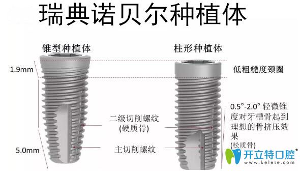 瑞典諾貝爾種植體優(yōu)勢