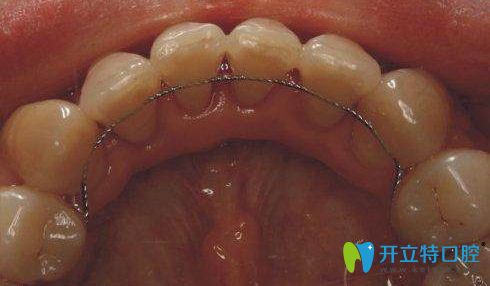 舌側(cè)固定保持器