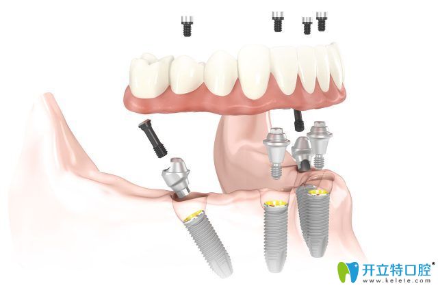 瑞士blt種植體是什么材質(zhì)？細(xì)數(shù)iti blt種植體優(yōu)缺點有哪些？