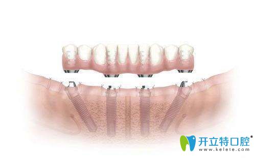半口種植牙介紹圖