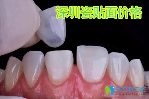 深圳瓷貼面多少錢(qián)一顆?請(qǐng)看超薄全瓷貼面品牌排行及價(jià)格