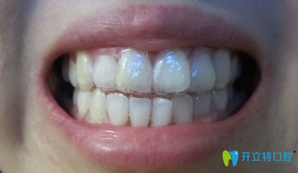隱形牙套真人佩戴