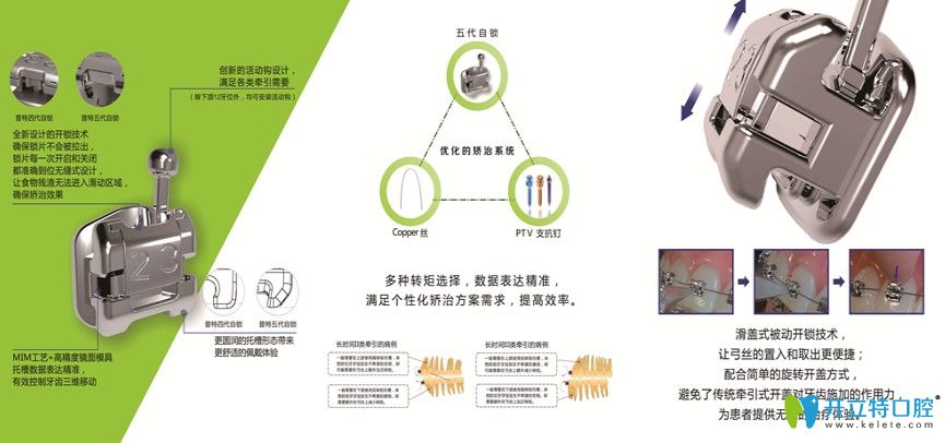 普特五代托槽優(yōu)勢(shì)