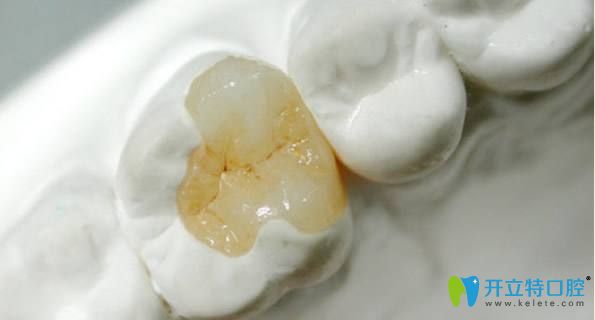 補牙的另一種方法——嵌體 補牙的另一種方法——嵌體