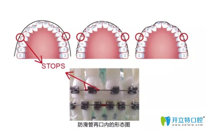 分享國(guó)產(chǎn)普特自鎖托槽價(jià)格是多少?普特3代和5代托槽怎么選