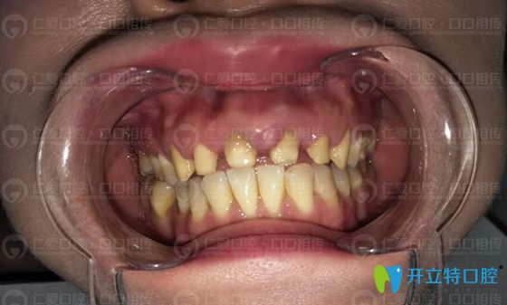 顧客在<!--<i data=20240703-sp></i>-->口腔修復烤瓷牙術(shù)前照