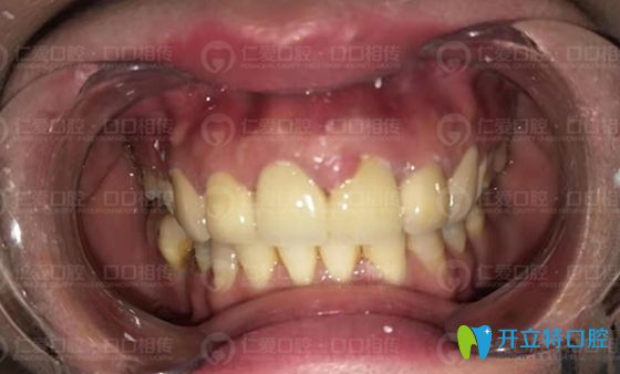 <!--<i data=20240703-sp></i>-->口腔對烤瓷牙失敗的修復效果