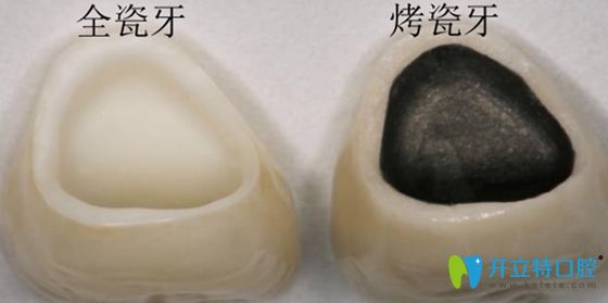 全瓷牙套和烤瓷牙套對比圖