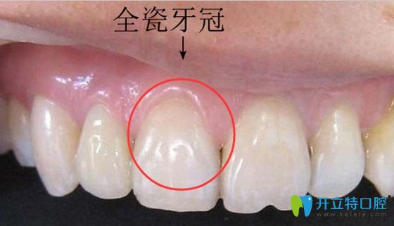 全瓷牙冠修復效果圖