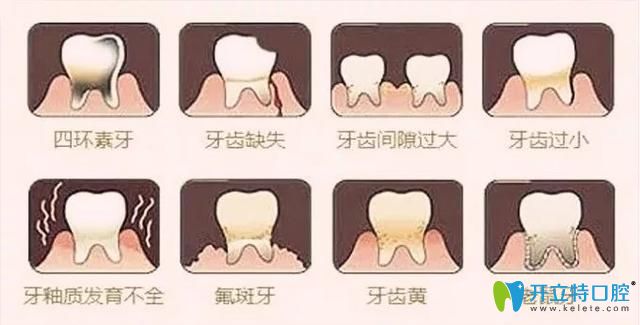 牙齒貼面適合人群
