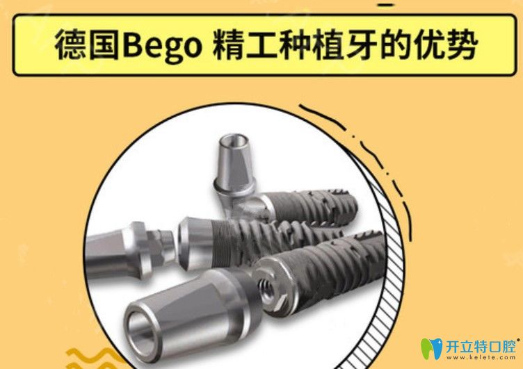 德國(guó)bego種植牙優(yōu)勢(shì)