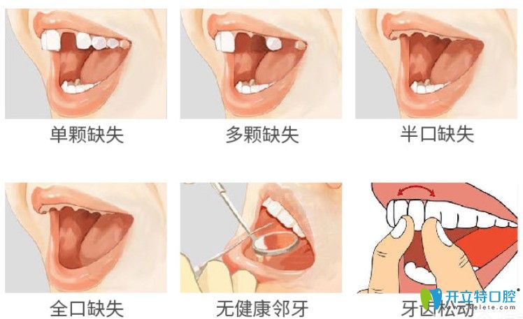 瑞士iti種植牙的優(yōu)勢(shì)