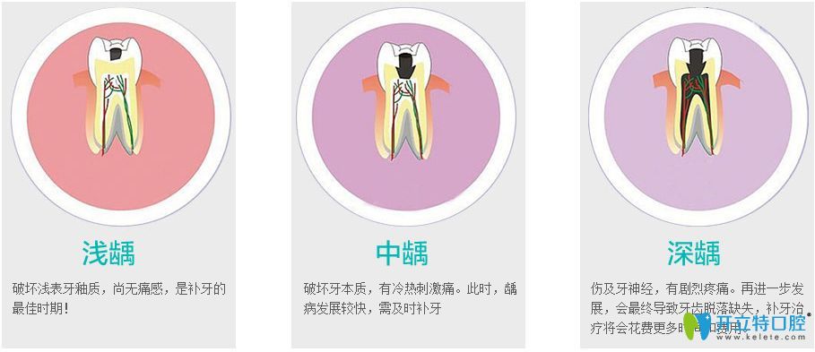 不同程度齲齒介紹圖