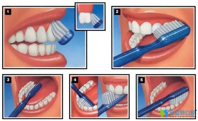做完牙周治療后正確的刷牙方式