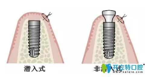 種植體埋入和非埋入式區(qū)別