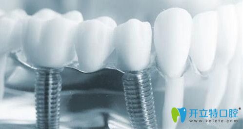 廣州瑞德口腔種植牙的優(yōu)點(diǎn)