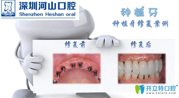 搞到了深圳世紀河山口腔全口/多顆種植牙成功案例對比圖片