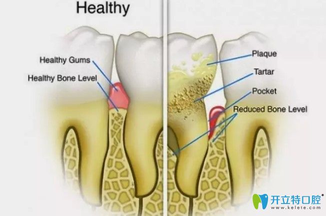 樸月梅醫(yī)生告訴大家牙周治療后的注意事項(xiàng)