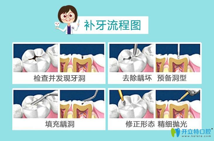 補(bǔ)牙流程圖示