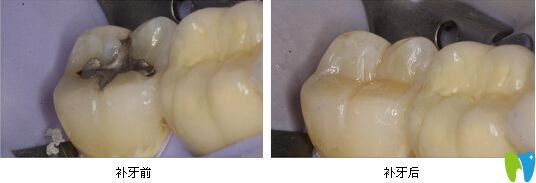 補(bǔ)牙前后對比圖