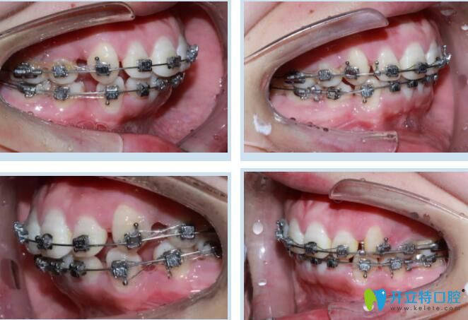 惠州致美口腔門診部牙齒矯正好嗎 惠州致美口腔門診部牙齒矯正好嗎