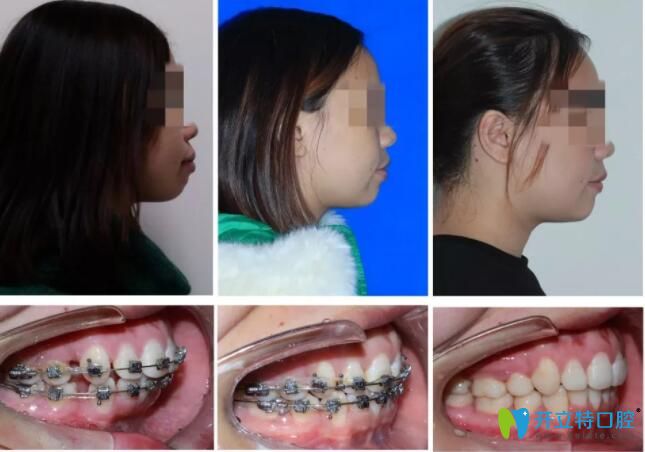惠州致美口腔牙齒矯正前后對比 惠州致美口腔牙齒矯正前后對比