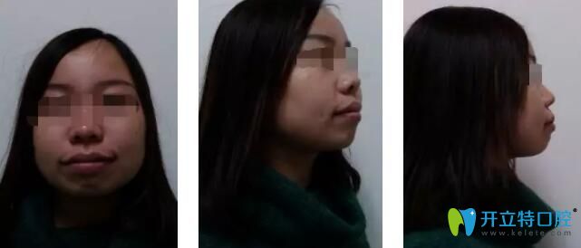 惠州哪里整牙比較好,致美口腔齙牙矯正案例超贊,附良心總結