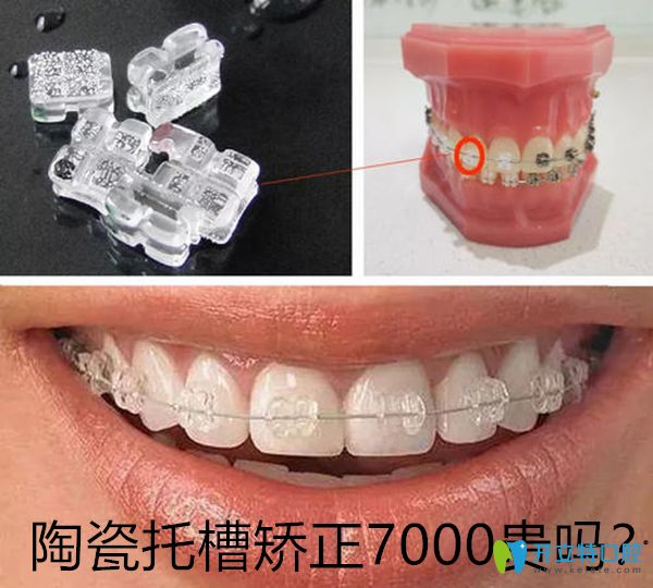 陶瓷托槽矯正7000元貴嗎?與15000自鎖托槽的優(yōu)缺點(diǎn)和區(qū)別是啥