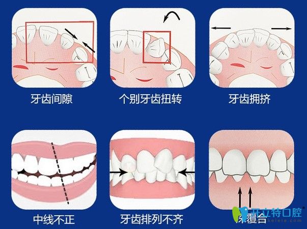 廣州壹加壹口腔告訴你佩戴隱形牙套的注意事項
