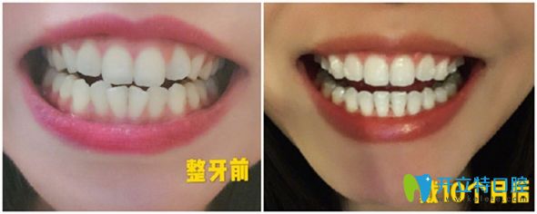 時(shí)代天使隱形矯正10個(gè)月前后效果圖