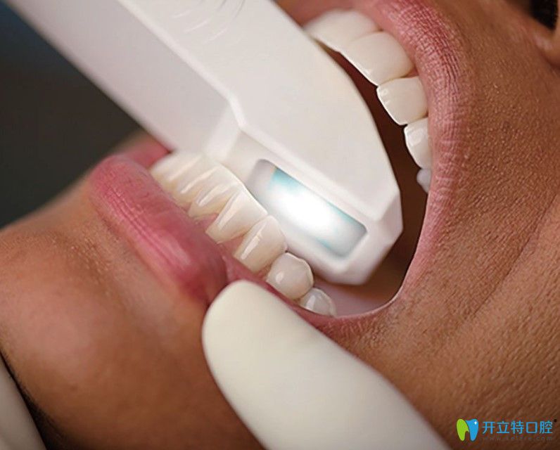 itero口內(nèi)掃描儀步驟