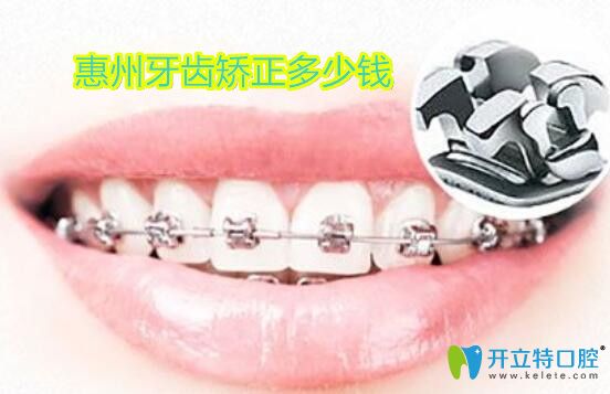 惠州帶牙套多少錢?內(nèi)附隱形和鋼絲牙齒矯正價(jià)格及醫(yī)院名單