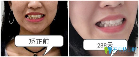 武漢仁愛口腔科正畸怎么樣?通過牙齒矯正案例效果來了解吧