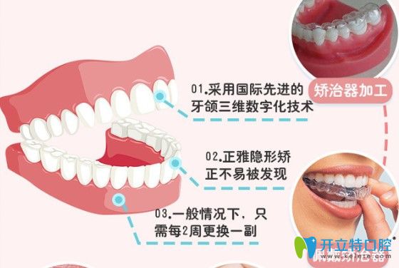 正雅隱形矯正好不好