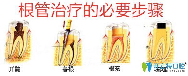 根管治療必要步驟