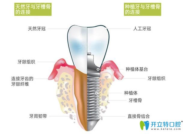 生物活性種植牙 生物活性種植牙