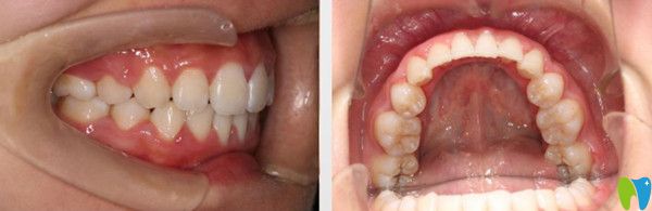 成都圣貝牙科正畸如何？附網(wǎng)友整牙的感受及圣貝箍牙價格