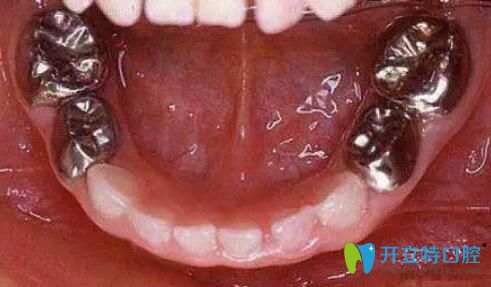 試戴預(yù)成冠